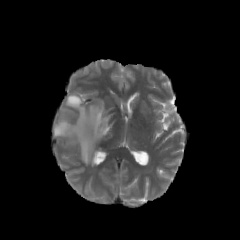 Brain MRI with tumor (SLAKE xmlab449)